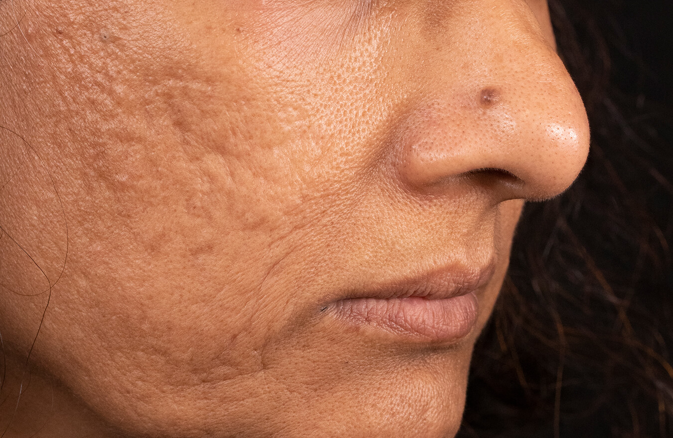 A female patient before using BIOJUVE.