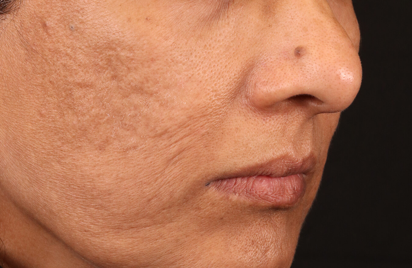 A female patient after using BIOJUVE.